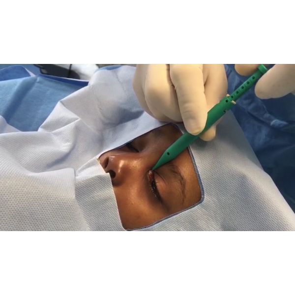 LacriJet stent and inserter shown in sterile packaging, ready for single-use lacrimal duct surgery.
